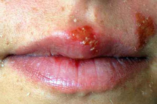 herpes remedy on the lip